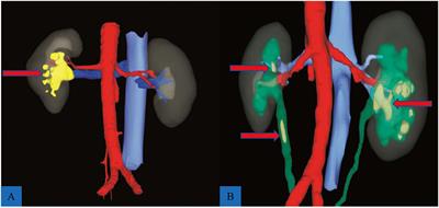 Assessment of Three-Dimensional Reconstruction in Percutaneous Nephrolithotomy for Complex Renal Calculi Treatment